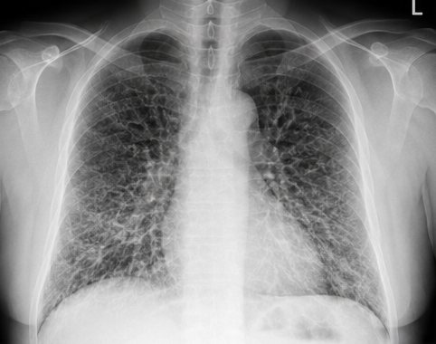 Chest X-ray showing a diffuse reticular pattern seen in fibrotic ILD