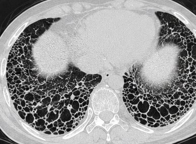 Axial HRCT chest image showing an established, severe fibrotic pattern