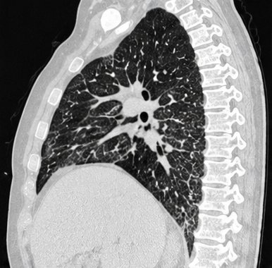 Sagittal HRCT chest image showing a fibrotic interstitial lung disease pattern